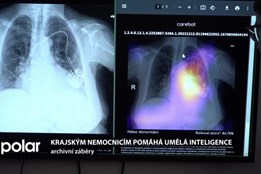 Krajským nemocnicím pomáhá umělá inteligence, možnosti se dále rozšiřují